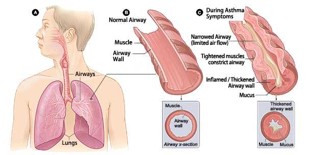 Pneumonia. sumber: www.airphysio.com