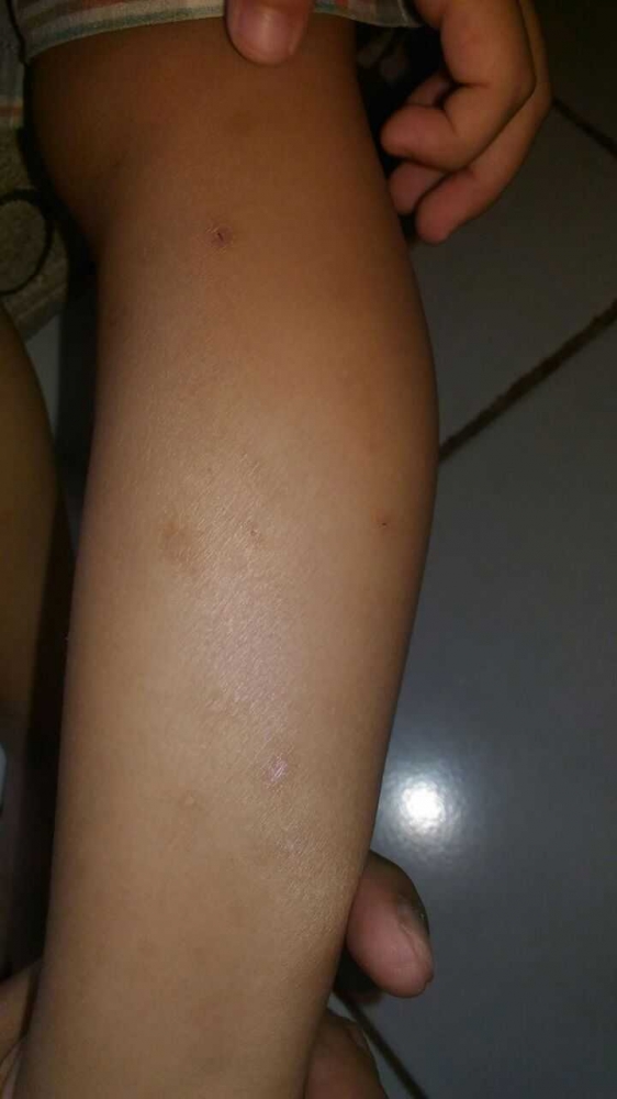 Kondisi kaki Kayama setelah mengganti sufor dengan soya, eksimnya membaik hanya sesekali kambuh karena lingkungan