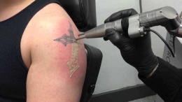 Tattoo laser removal (Sumber: authoritytattoo.com)