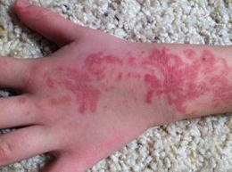 Reaksi alergi akibat tato (Sumber: fda.gov)