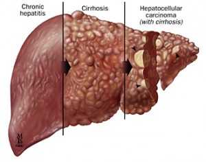 Gambar hati terkena hepatitis (gambar:pphi-online.org)