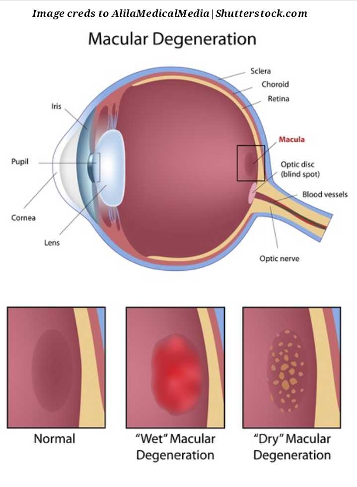 Penyakit degenerasi atau penuaan makula. Sumber gambar: AlilaMedicalMedia|Shutterstock.com