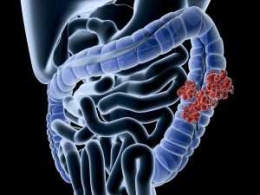 Bakteri penyebab diare, E.coli/warna merah, menempel di saluran pencernaan dan mengeluarkan racun yang membuat perut melilit (www.sepsis.org)