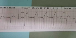 Rekam jantung infarct (dok.pri.)