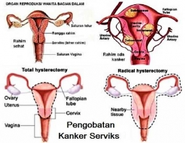 Pengobatan Kanker Serviks - Sumber Gambar: Sitekno 