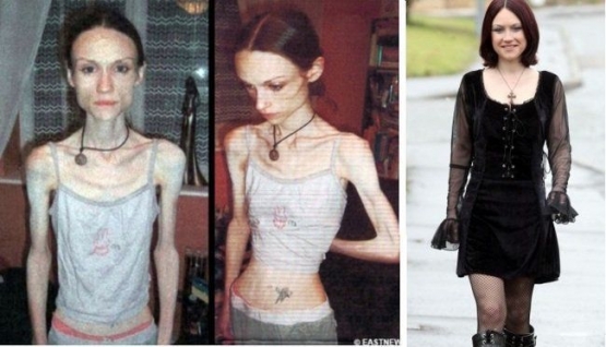Penderita Anorexia | Newsner.com