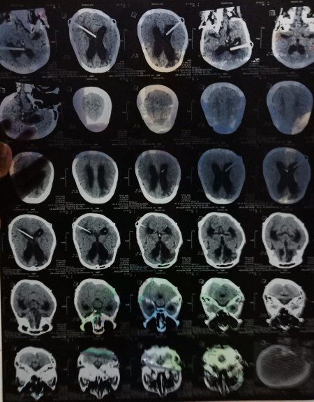 Dua Belas Kali Operasi Bedah Saraf Gratis Berkat Bpjs Halaman 1 Kompasiana Dua Belas Kali Operasi Bedah Saraf Gratis Berkat Bpjs Halaman 1 Kompasiana