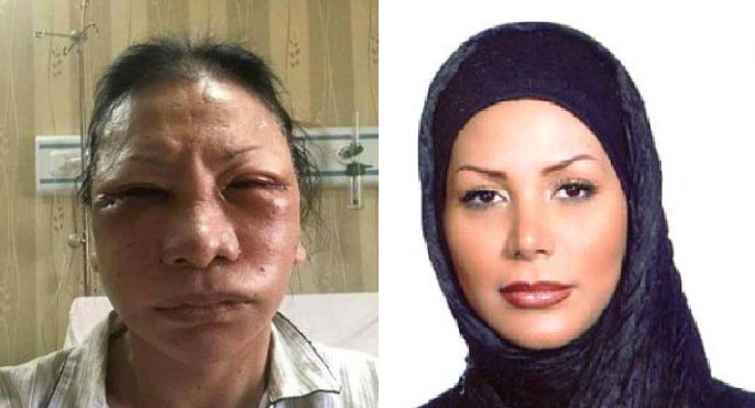Foto wajah bonyok Ratna Sarumpaet dan wajah cantik Neda Agha Soltani (Diolah dari Tribunnews.com dan BBC.com)