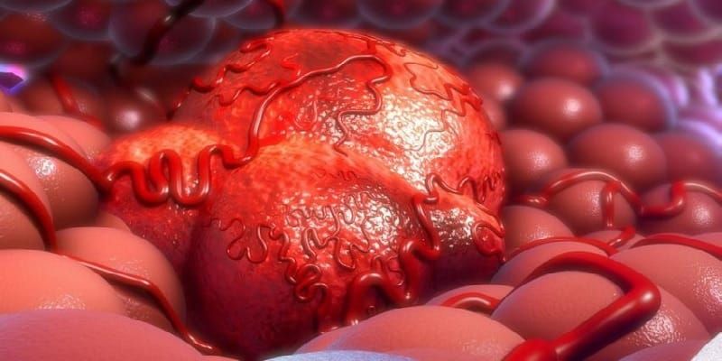 10 1 Kanker Merupakan Tumor Ganas Yg Ditandai Depertumbuhan