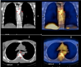 Foto pencitraan SPECT/CT rongga dada dari seorang pasien TB aktif. Berdasarkan hasil uji spesimen jaringan, pasien tersebut mengalami peradangan pada ruas tulang belakang dalam rongga dada akibat infeksi bakteri TB (ditandai dengan garis merah) . Gambar sebelah kiri merupakan citra sebelum pasien diinjeksi Tc 99m-etambutol, sedangkan gambar sebelah kanan adalah citra setelah pasien diinjeksi Tc 99m-etambutol. Penggunaan radiofarmaka Tc 99m-etambutol tidak hanya memperjelas lokasi peradangan pada tulang, tetapi juga lokasi infeksi TB di sekitar area tulang (ditunjukkan dengan warna kuning keemasan pada gambar sebelah kanan). Gambar diambil dari Kartamihardja, A. H. S. dkk., Diagnostic value of 99mTc-ethambutol scintigraphy in tuberculosis: compared to microbiological and histopatological tests, Annals of Nuclear Medicine 32: 60-68, 2018.