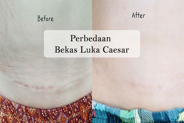 Perbandingan Luka Bekas Caesar Setelah Konsumsi Kapsul Kutuk Premium
