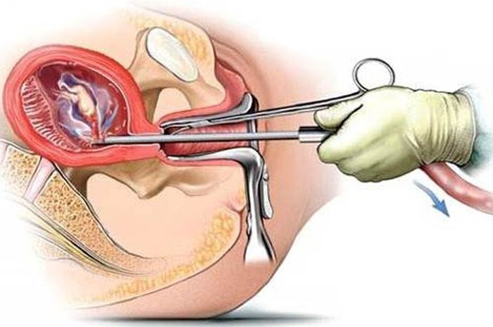 Ilustrasi kuretase (Sumber gambar https://safeparenthood.org)