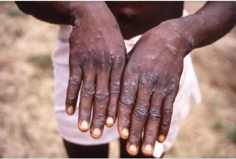 Penderita Cacar Monyet (Monkeypox), foto straitstime.com