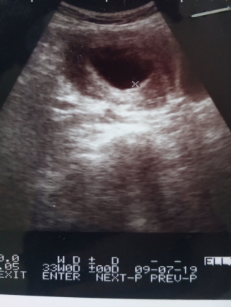 Pengalaman Saat Alami Kehamilan Kosong Blighted Ovum