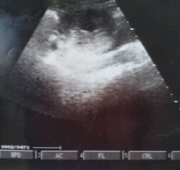 Hasil USG pertama saat alami kehamilan kosong | Dokpri