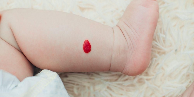 Mengetahui cara mengatasi hemangioma pada bayi (Sumber : shutterstock.com)