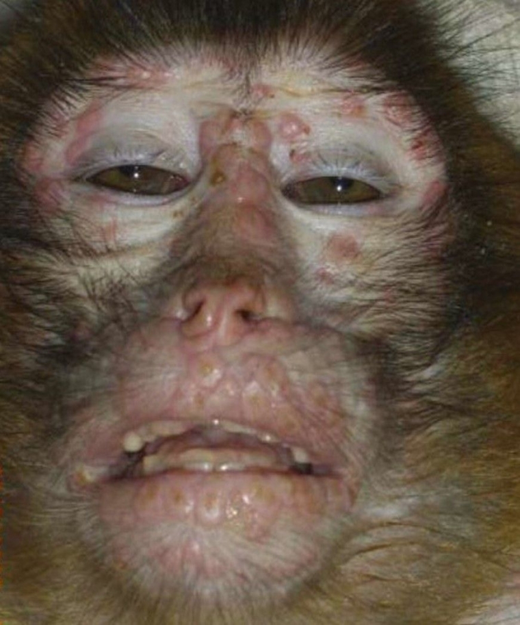 Cacar Monyet (Monkeypox): Kenali Gejala & Waspadai ...
