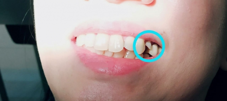gigi patah (dok. penulis)