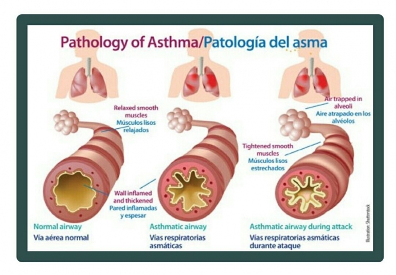 Penyakit asma - Sanarik.com