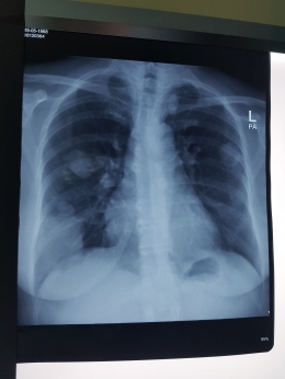 Foto Thoraks pasien dengan kanker paru