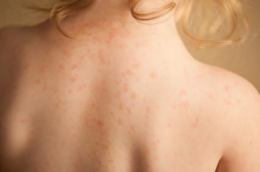 Bercak merah dan gatal di kulit merupakan gejala dermatitis atopi. (Dok: chla.org)