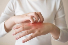 Ilustrasi alergi pada kulit (Sumber: www.theextract.co.uk)
