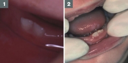 Photo guide: tooth eruption in children Images courtesy of Richard Welbury 