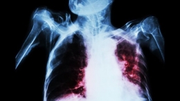 TB menyebabkan kersusakan paru paru. Photo: Thinkstock 