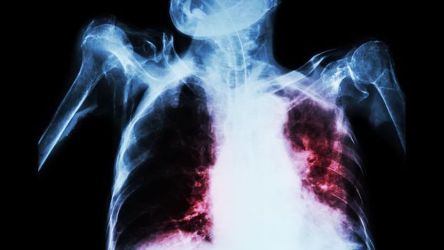 TB menyebabkan kersusakan paru paru. Photo: Thinkstock