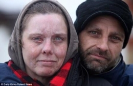 Carla Whitlock 6 bulan setelah penyerangan dirinya dengan asam sulfat dengan tingkat kepekatan 87-93# (Sumber: Daily Mail)