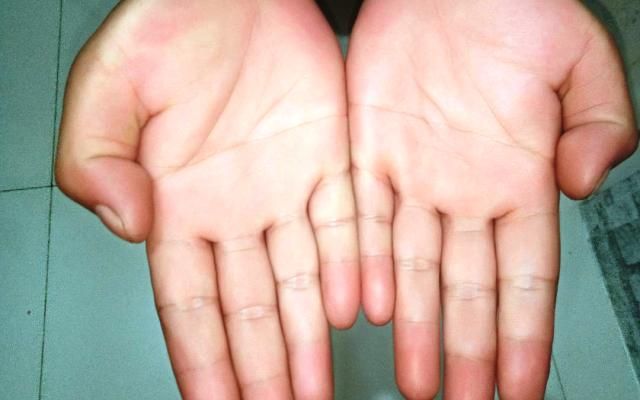 Nadiem Makarim Dan Mitos Simian Line Garis Tangan Langka Di Dunia Halaman 1 Kompasiana Com