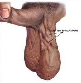 Varikokel, pembengkakan pembuluh darah vena di sekitar genitalia. Sumber gambar Medium.com