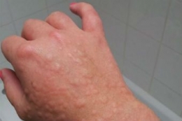 contoh penampakan alergi dingin. | www.abc.net.au