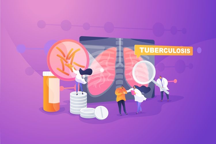 Ilustrasi TBC, tuberculosis (Shutterstock) via Kompas.com
