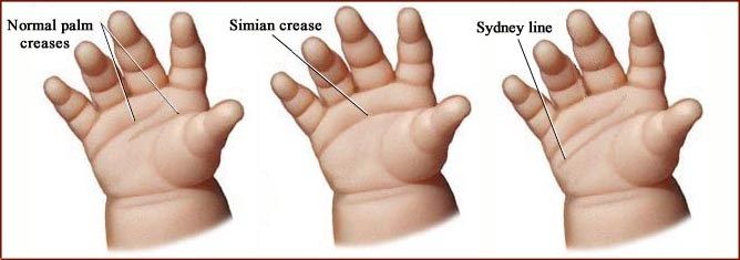Ilustrasi Simian Crease dan Sydney Crease. Sumber: palmreadingperspectives.wordpress.com
