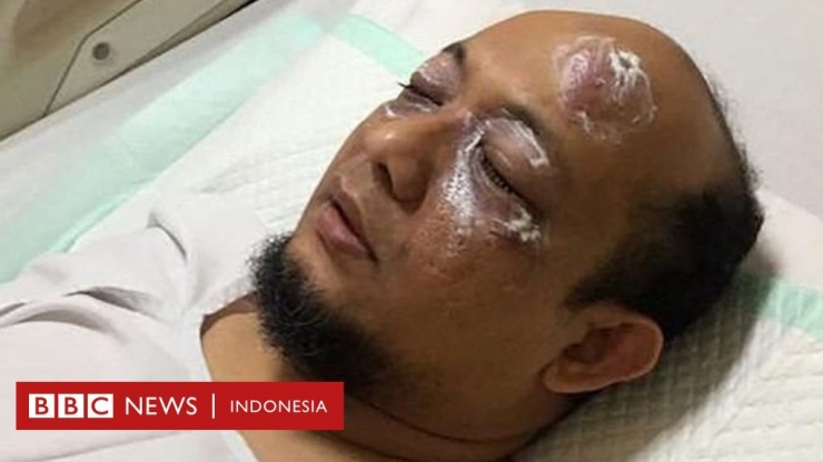 Foto : Novel Baswedan Sebagai Korban dari WNI Keturunan Arab| BBC News Indonesia
