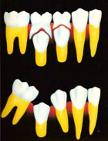 Gambar gigi tetap yang miring dan menutup tempat gigi tetap sebelahnya akibat gigi susu tanggal terlalu cepat. sumber: dentist-westran
