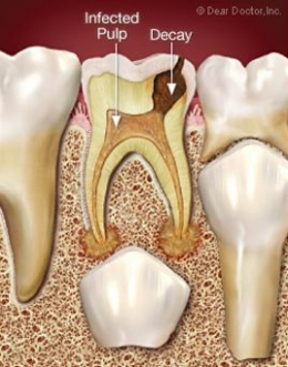 Gigi berlubang yang tidak dirawat menyebabkan infeksi dan dapat mengganggu pertumbuhan gigi tetap yang sedang berlangsung di dalamnya, sumber: deardoctor.com
