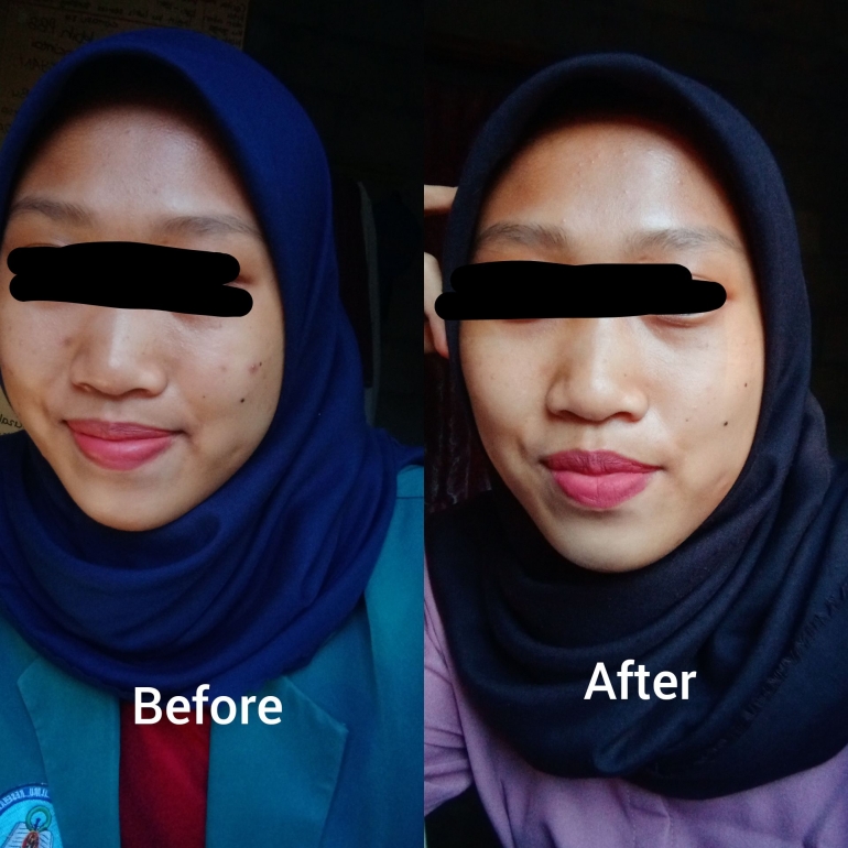 Before after penggunaan produk Larissa (Sumber: foto pribadi)