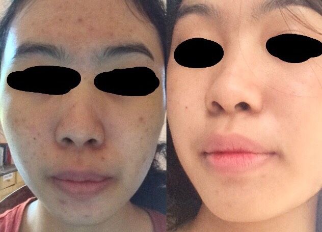 Foto 2. Langganan Larissa udah 1 tahun, tapi biasalah kalo stress jerawat suka muncul tiba-tiba, tapi dengan sekali facial jerawat langsung hempas (Dokpri)