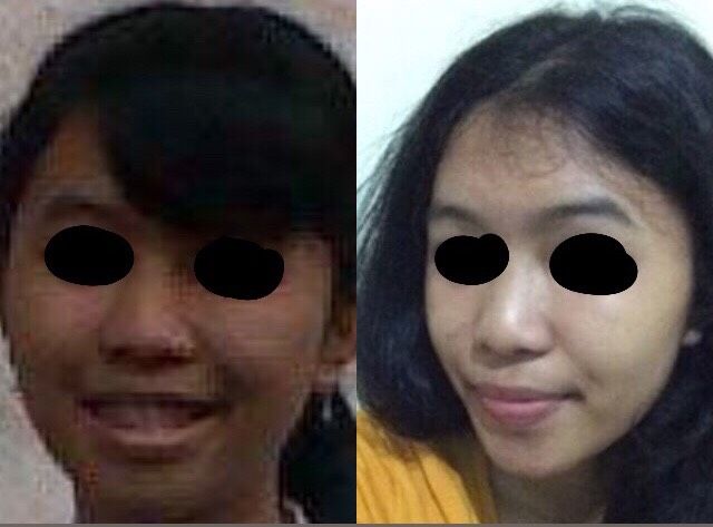 Foto 1. Setelah 2 Bulan Perawatan Rutin di Larissa, Kontras Banget Kelihatannya Tapi Saya Sudah jelaskan di Deskripsi di Bawah Yah (Dokpri)