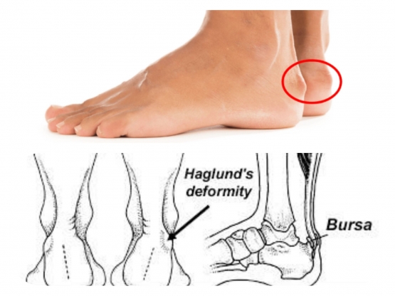Haglund's deformity pada tumit | diolah dari berbagai sumber