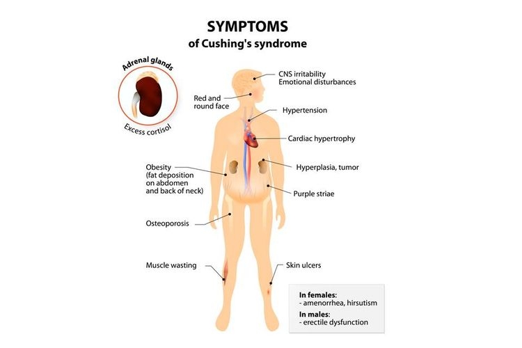 Cushing Syndrome| Sumber: Shutterstock via Kompas.com