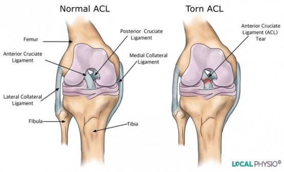 Perbandingan kondisi ligamen lutut (ACL) normal [kiri] dan cedera [kanan] | local-physio.co.uk