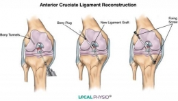 Rekontruksi atau operasi cedera ACL pada lutut. | Foto: local-physio.co.uk via thisisanfield.com