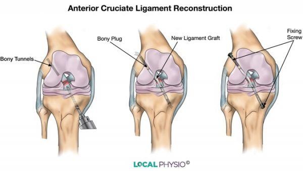 Rekontruksi atau operasi cedera ACL pada lutut. | Foto: local-physio.co.uk via thisisanfield.com