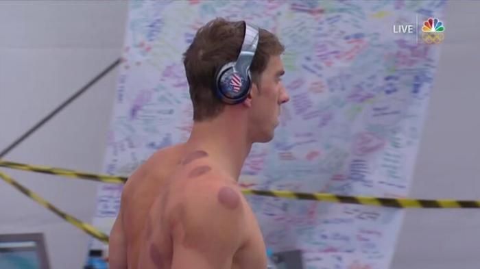 Michael Phelps, juara renang dunia terapi Bekam (tribunews.com)