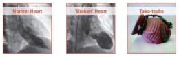 Contoh Xray dari jantung yang normal dan jantung bengkak karena kondisi Broken Heart Syndrome. foto diambil dari University of Iowa Hospitals & Clinic