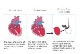 Ilustrasi ini mengambarkan perbandingkan jantung normal dan jantung dalam kondisi Broken Heart Syndrome yang terjadi pembengkakan. Sumber dari Cardio Secur