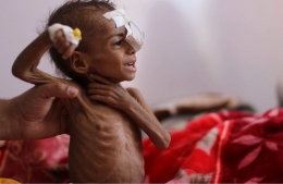 Anak perempuan yang mengalami malnurisi di rumah sakit al-Sabeen di ibukota Yaman Sanaa tanggal 27 October 2020. Sumber: Khaled Abdullah/Reuters